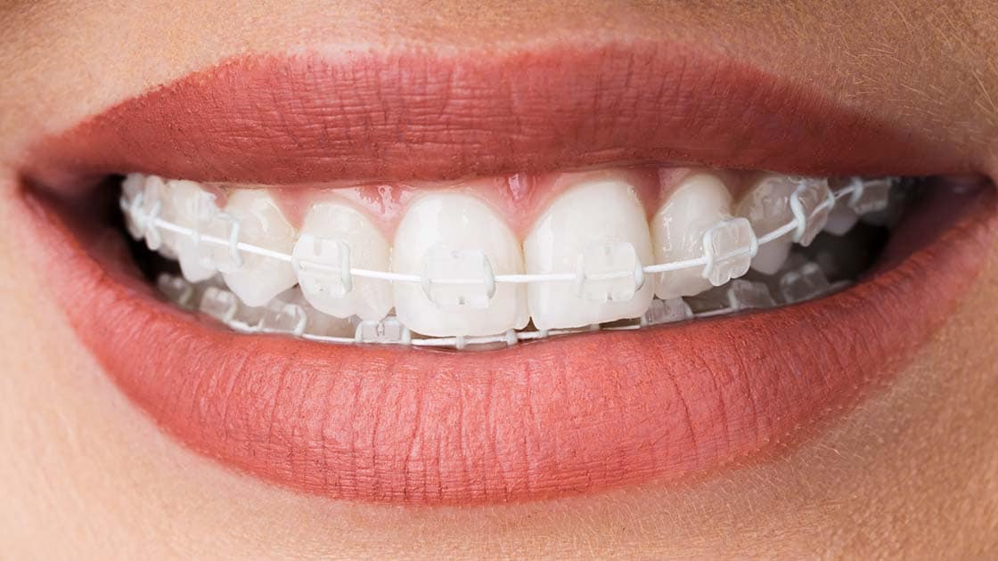 Ask Your North Houston and East Texas Dentist: Should I Get Metal or Clear  Braces?, Element Dental & Orthodontics