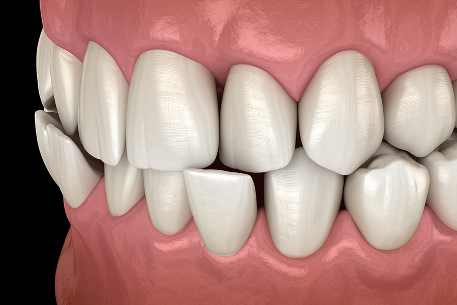 Braces to correct crossbite