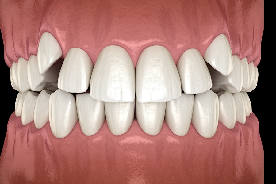 Braces to correct excessive crowding