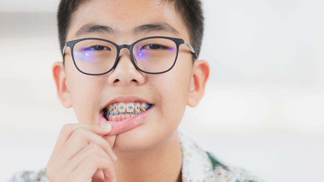 First Days in Braces Image