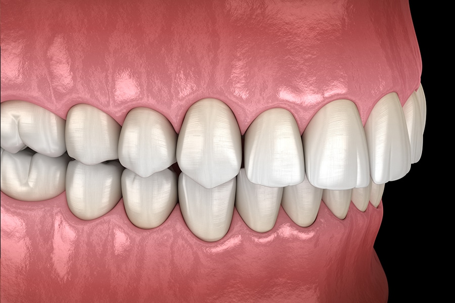 Braces to correct overbite