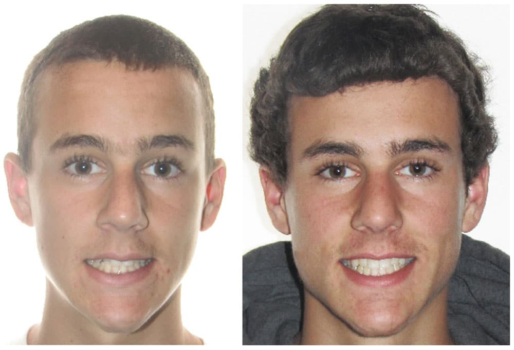 Invisalign Before and After Image