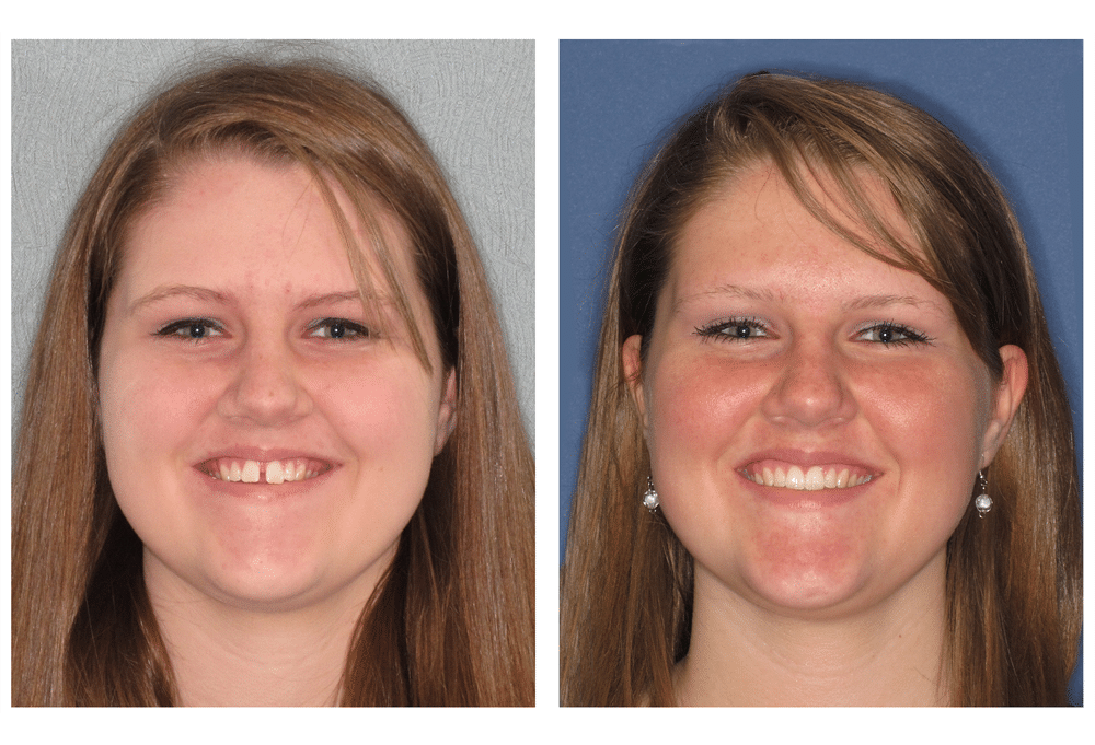 Invisalign Before and After Image